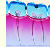 虫歯の種類C1