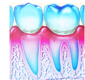 歯周病2